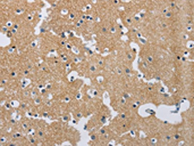 The image on the left is immunohistochemistry of paraffin-embedded Human brain tissue using the antibody Antibody) at dilution 1/40, on the right is treated with synthetic peptide. (Original magnification: ×200)Rabbit anti-Human SYN2 Polyclonal Antibody
