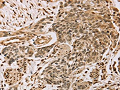 The image on the left is immunohistochemistry of paraffin-embedded Human esophagus cancer tissue using CENPV Antibody(CENPV Antibody) at dilution 1/30, on the right is treated with synthetic peptide. (Original magnification: ×200)Rabbit anti-Human CENPV Polyclonal Antibody