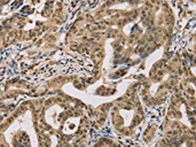 The image on the left is immunohistochemistry of paraffin-embedded Human gastic cancer tissue using the antibody Antibody) at dilution 1/30, on the right is treated with synthetic peptide. (Original magnification: ×200)Rabbit anti-Human CENPV Polyclonal Antibody