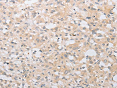 The image on the left is immunohistochemistry of paraffin-embedded Human thyroid cancer tissue using ATG9A Antibody(ATG9A Antibody) at dilution 1/30, on the right is treated with fusion protein. (Original magnification: ×200)