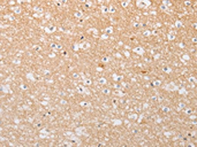 The image on the left is immunohistochemistry of paraffin-embedded Human brain tissue using the antibody Antibody) at dilution 1/30, on the right is treated with fusion protein. (Original magnification: ×200)