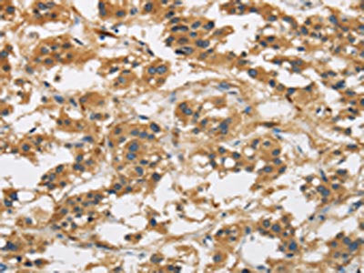 The image is immunohistochemistry of paraffin-embedded Human thyroid cancer tissue using the antibody Antibody) at dilution 1/50. (Original magnification: ×200)Rabbit anti-Human GAS7 Polyclonal Antibody