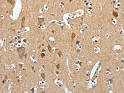 The image on the left is immunohistochemistry of paraffin-embedded Human brain  tissue using RCAN1 Antibody(RCAN1 Antibody) at dilution 1/45, on the right is treated with synthetic peptide. (Original magnification: ×200)Rabbit anti-Human RCAN1 Polyclonal Antibody