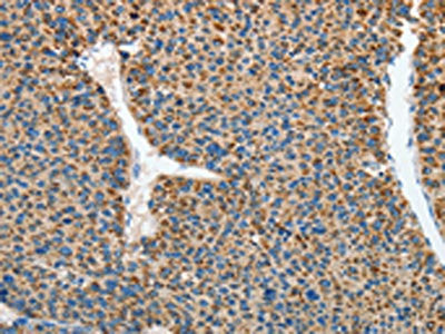 The image on the left is immunohistochemistry of paraffin-embedded Human liver cancer tissue using the antibody Antibody) at dilution 1/45, on the right is treated with synthetic peptide. (Original magnification: ×200)Rabbit anti-Human RCAN1 Polyclonal Antibody