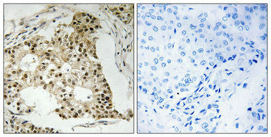 Immunohistochemistry analysis of paraffin-embedded human breast carcinoma tissue using Retinoic Acid Receptor α (Phospho-Ser77) antibody. The picture on the right is treated with the synthesized peptide.Rabbit anti-Human RARA Polyclonal Antibody