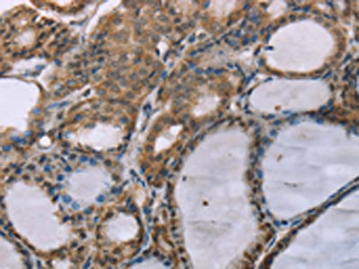 The image on the left is immunohistochemistry of paraffin-embedded Human thyroid cancer tissue using ACTN2 Antibody(ACTN2 Antibody) at dilution 1/30, on the right is treated with synthetic peptide. (Original magnification: x200)Rabbit anti-Human ACTN2 Polyclonal Antibody