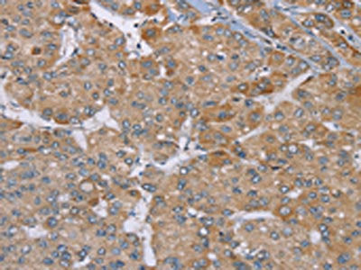 The image on the left is immunohistochemistry of paraffin-embedded Human liver cancer tissue using the antibody Antibody) at dilution 1/30, on the right is treated with synthetic peptide. (Original magnification: x200)