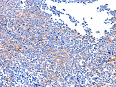 The image on the left is immunohistochemistry of paraffin-embedded Human ovarian cancer tissue using PTK2 Antibody(PTK2 Antibody) at dilution 1/75, on the right is treated with synthetic peptide. (Original magnification: ×200)