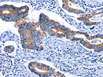 The image on the left is immunohistochemistry of paraffin-embedded Human colon cancer tissue using STAT5A Antibody(STAT5A Antibody) at dilution 1/25, on the right is treated with fusion protein. (Original magnification: ×200)Rabbit anti-Human STAT5A Polyclonal Antibody