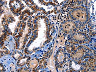 The image on the left is immunohistochemistry of paraffin-embedded Human thyroid cancer tissue using the antibody Antibody) at dilution 1/25, on the right is treated with fusion protein. (Original magnification: ×200)Rabbit anti-Human STAT5A Polyclonal Antibody