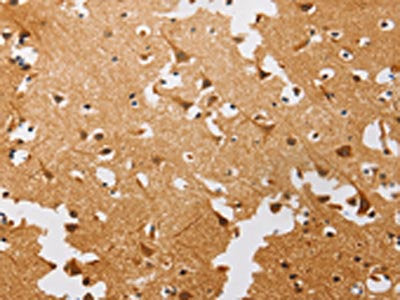 The image on the left is immunohistochemistry of paraffin-embedded Human brain tissue using the antibody Antibody) at dilution 1/20, on the right is treated with fusion protein. (Original magnification: ×200)