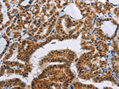 The image on the left is immunohistochemistry of paraffin-embedded Human thyroid cancer tissue using the antibody Antibody) at dilution 1/55, on the right is treated with fusion protein. (Original magnification: ×200)