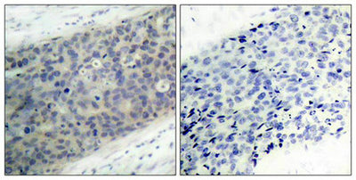 Immunohistochemical analysis of paraffin-embedded human breast carcinoma tissue using LIMK2(Phospho-Thr505) Antibody(left) or the same antibody preincubated with blocking peptide(right).