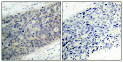 Immunohistochemical analysis of paraffin-embedded human breast carcinoma tissue using LIMK2(Phospho-Thr505) Antibody(left) or the same antibody preincubated with blocking peptide(right).