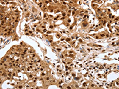 The image on the left is immunohistochemistry of paraffin-embedded Human lung cancer tissue using SRF Antibody(SRF Antibody) at dilution 1/30, on the right is treated with synthetic peptide. (Original magnification: ×200)Rabbit anti-Human SRF Polyclonal Antibody