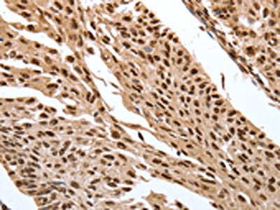 The image on the left is immunohistochemistry of paraffin-embedded Human cervical cancer tissue using the antibody Antibody) at dilution 1/30, on the right is treated with synthetic peptide. (Original magnification: ×200)Rabbit anti-Human SRF Polyclonal Antibody