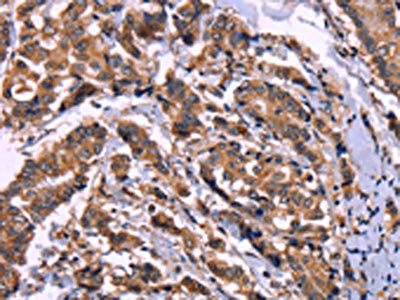 The image on the left is immunohistochemistry of paraffin-embedded Human breast cancer tissue using AMIGO2 Antibody(AMIGO2 Antibody) at dilution 1/50, on the right is treated with fusion protein. (Original magnification: ×200)Rabbit anti-Human AMIGO2 Polyclonal Antibody