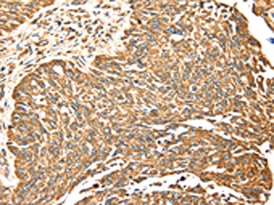 The image on the left is immunohistochemistry of paraffin-embedded Human lung cancer tissue using MAPK7 Antibody(MAPK7 Antibody) at dilution 1/20, on the right is treated with fusion protein. (Original magnification: ×200)