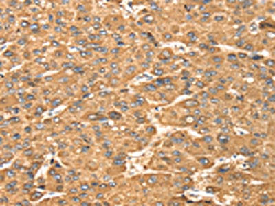 The image on the left is immunohistochemistry of paraffin-embedded Human liver cancer tissue using the antibody Antibody) at dilution 1/20, on the right is treated with fusion protein. (Original magnification: ×200)