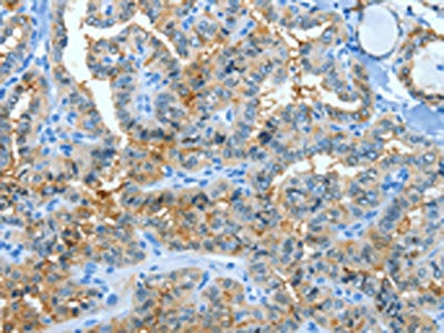 The image on the left is immunohistochemistry of paraffin-embedded Human thyroid cancer tissue using ANXA3 Antibody(ANXA3 Antibody) at dilution 1/25, on the right is treated with fusion protein. (Original magnification: ×200)Rabbit anti-Human ANXA3 Polyclonal Antibody