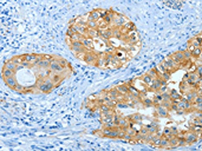 The image on the left is immunohistochemistry of paraffin-embedded Human cervical cancer tissue using the antibody Antibody) at dilution 1/25, on the right is treated with fusion protein. (Original magnification: ×200)Rabbit anti-Human ANXA3 Polyclonal Antibody