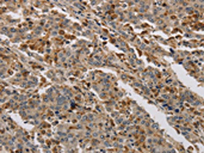 The image on the left is immunohistochemistry of paraffin-embedded Human liver cancer tissue using KDM4A Antibody(KDM4A Antibody) at dilution 1/40, on the right is treated with synthetic peptide. (Original magnification: ×200)