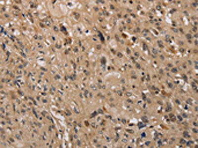 The image on the left is immunohistochemistry of paraffin-embedded Human esophagus cancer tissue using the antibody Antibody) at dilution 1/40, on the right is treated with synthetic peptide. (Original magnification: ×200)
