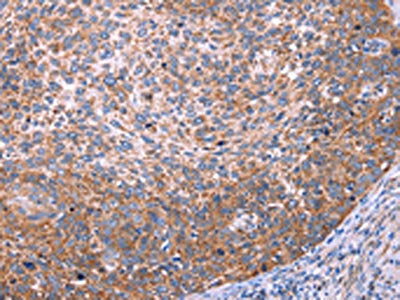 The image on the left is immunohistochemistry of paraffin-embedded Human cervical cancer tissue using the antibody Antibody) at dilution 1/20, on the right is treated with synthetic peptide. (Original magnification: ×200)Rabbit anti-Human FUT8 Polyclonal Antibody