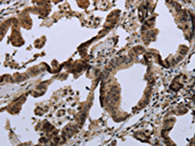 The image on the left is immunohistochemistry of paraffin-embedded Human colon cancer tissue using MAPKAPK2 Antibody(MAPKAPK2 Antibody) at dilution 1/20, on the right is treated with synthetic peptide. (Original magnification: ×200)