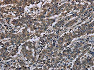 The image on the left is immunohistochemistry of paraffin-embedded Human liver cancer tissue using the antibody Antibody) at dilution 1/20, on the right is treated with synthetic peptide. (Original magnification: ×200)