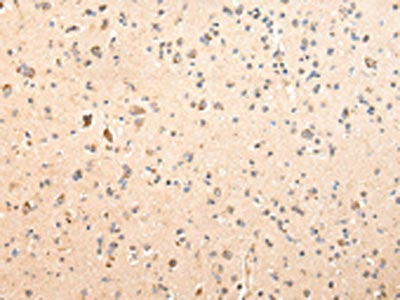 The image on the left is immunohistochemistry of paraffin-embedded Human brain tissue using SDCBP Antibody(SDCBP Antibody) at dilution 1/40, on the right is treated with fusion protein. (Original magnification: ×200)Rabbit anti-Human SDCBP Polyclonal Antibody