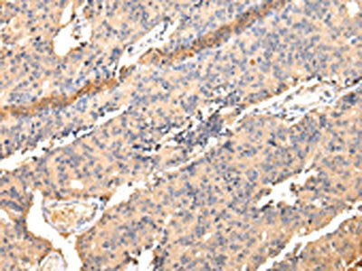 The image on the left is immunohistochemistry of paraffin-embedded Human prostate cancer tissue using the antibody Antibody) at dilution 1/40, on the right is treated with fusion protein. (Original magnification: ×200)Rabbit anti-Human SDCBP Polyclonal Antibody