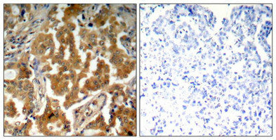 Immunohistochemical analysis of paraffin-embedded human lung carcinoma tissue using ADD1(Phospho-Ser726) Antibody(left) or the same antibody preincubated with blocking peptide(right).Rabbit anti-Human ADD1 Polyclonal Antibody