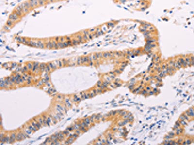 The image on the left is immunohistochemistry of paraffin-embedded Human colon cancer tissue using ADAMTS17 Antibody(ADAMTS17 Antibody) at dilution 1/60, on the right is treated with synthetic peptide. (Original magnification: ×200)Rabbit anti-Human ADAMTS17 Polyclonal Antibody