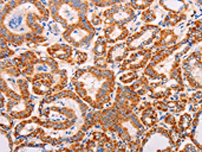 The image on the left is immunohistochemistry of paraffin-embedded Human thyroid cancer tissue using the antibody Antibody) at dilution 1/60, on the right is treated with synthetic peptide. (Original magnification: ×200)