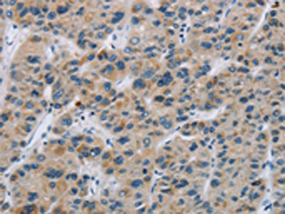 The image on the left is immunohistochemistry of paraffin-embedded Human liver cancer tissue using SYN2 Antibody(SYN2 Antibody) at dilution 1/40, on the right is treated with synthetic peptide. (Original magnification: ×200)Rabbit anti-Human SYN2 Polyclonal Antibody