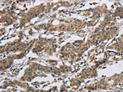 The image on the left is immunohistochemistry of paraffin-embedded Human gastic cancer tissue using the antibody Antibody) at dilution 1/40, on the right is treated with synthetic peptide. (Original magnification: ×200)Rabbit anti-Human SYN2 Polyclonal Antibody