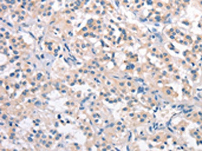 The image on the left is immunohistochemistry of paraffin-embedded Human thyroid cancer tissue using CRHR2 Antibody(CRHR2 Antibody) at dilution 1/25, on the right is treated with synthetic peptide. (Original magnification: ×200)Rabbit anti-Human CRHR2 Polyclonal Antibody