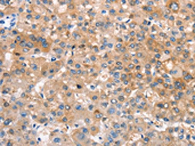 The image on the left is immunohistochemistry of paraffin-embedded Human liver cancer tissue using the antibody Antibody) at dilution 1/25, on the right is treated with synthetic peptide. (Original magnification: ×200)Rabbit anti-Human CRHR2 Polyclonal Antibody