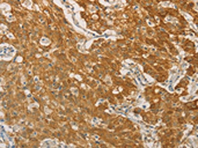 The image on the left is immunohistochemistry of paraffin-embedded Human gastric cancer tissue using PSMB7 Antibody(PSMB7 Antibody) at dilution 1/25, on the right is treated with fusion protein. (Original magnification: ×200)Rabbit anti-Human PSMB7 Polyclonal Antibody