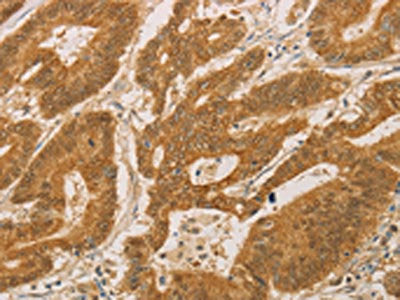 The image on the left is immunohistochemistry of paraffin-embedded Human colon cancer tissue using the antibody Antibody) at dilution 1/25, on the right is treated with fusion protein. (Original magnification: ×200)Rabbit anti-Human PSMB7 Polyclonal Antibody