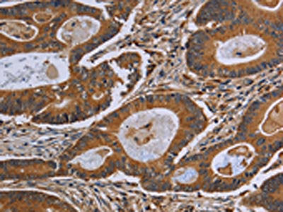 The image on the left is immunohistochemistry of paraffin-embedded Human colon cancer tissue using GJB4 Antibody(GJB4 Antibody) at dilution 1/40, on the right is treated with synthetic peptide. (Original magnification: ×200)Rabbit anti-Human GJB4 Polyclonal Antibody