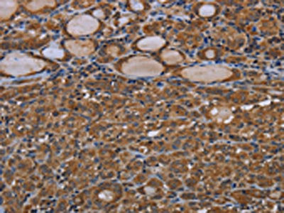 The image on the left is immunohistochemistry of paraffin-embedded Human thyroid cancer tissue using the antibody Antibody) at dilution 1/40, on the right is treated with synthetic peptide. (Original magnification: ×200)Rabbit anti-Human GJB4 Polyclonal Antibody
