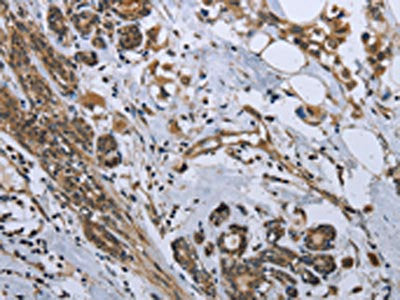 The image on the left is immunohistochemistry of paraffin-embedded Human breast cancer tissue using GDF3 Antibody(GDF3 Antibody) at dilution 1/25, on the right is treated with fusion protein. (Original magnification: ×200)Rabbit anti-Human GDF3 Polyclonal Antibody