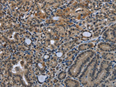 The image on the left is immunohistochemistry of paraffin-embedded Human thyroid cancer tissue using the antibody Antibody) at dilution 1/25, on the right is treated with fusion protein. (Original magnification: ×200)Rabbit anti-Human GDF3 Polyclonal Antibody