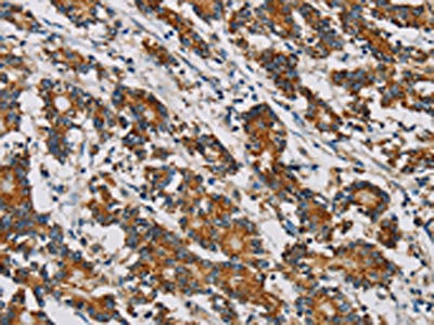 The image on the left is immunohistochemistry of paraffin-embedded Human colon cancer tissue using MRPL28 Antibody(MRPL28 Antibody) at dilution 1/20, on the right is treated with fusion protein. (Original magnification: ×200)
