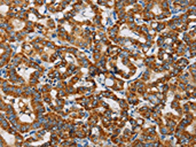 The image on the left is immunohistochemistry of paraffin-embedded Human thyroid cancer tissue using the antibody Antibody) at dilution 1/20, on the right is treated with fusion protein. (Original magnification: ×200)
