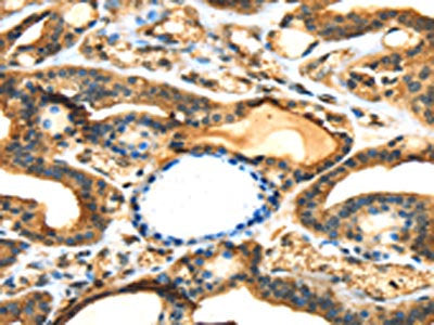 The image on the left is immunohistochemistry of paraffin-embedded Human thyroid cancer tissue using ANXA13 Antibody(ANXA13 Antibody) at dilution 1/15, on the right is treated with fusion protein. (Original magnification: ×200)Rabbit anti-Human ANXA13 Polyclonal Antibody