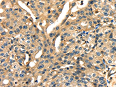 The image on the left is immunohistochemistry of paraffin-embedded Human gastic cancer tissue using the antibody Antibody) at dilution 1/15, on the right is treated with fusion protein. (Original magnification: ×200)Rabbit anti-Human ANXA13 Polyclonal Antibody