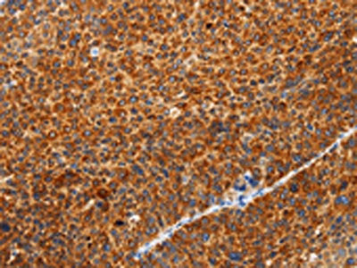 The image on the left is immunohistochemistry of paraffin-embedded Human liver cancer tissue using SPATA13 Antibody(SPATA13 Antibody) at dilution 1/20, on the right is treated with fusion protein. (Original magnification: ×200)